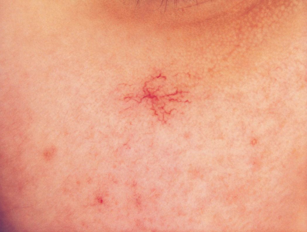 Купероз — заболевание сосудов кожи