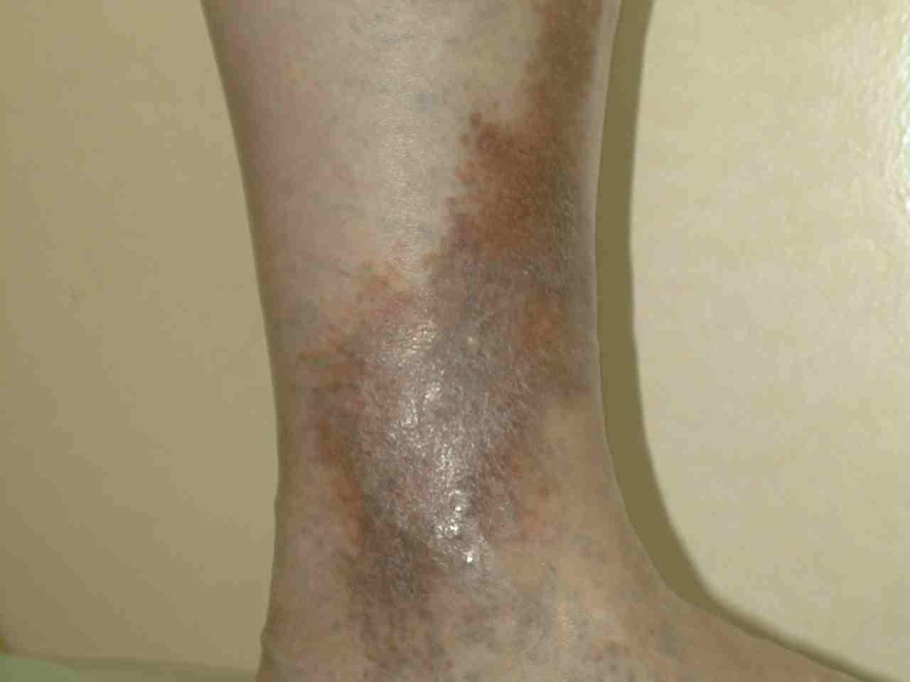 Признаки развития варикозной экземы на ногах