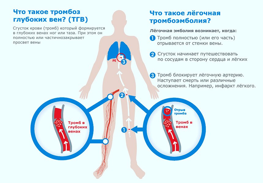 Тромбоз глубоких вен - описание и симптомы