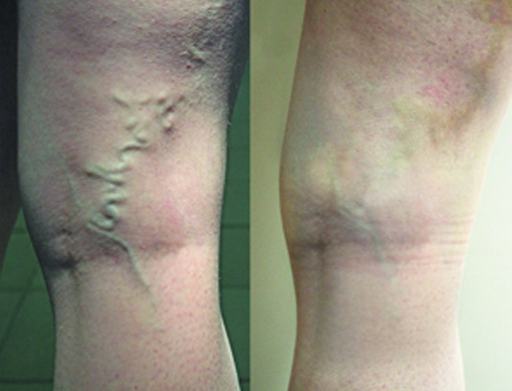 Осложнения от склеротерапии пораженных вен ног
