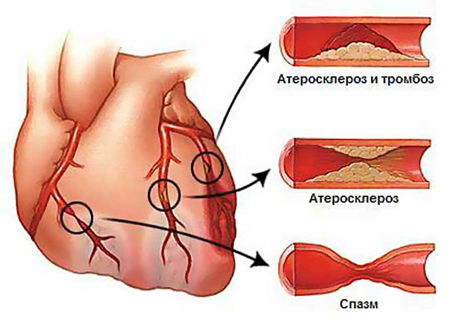 Что собой представляет склероз аорты сердца