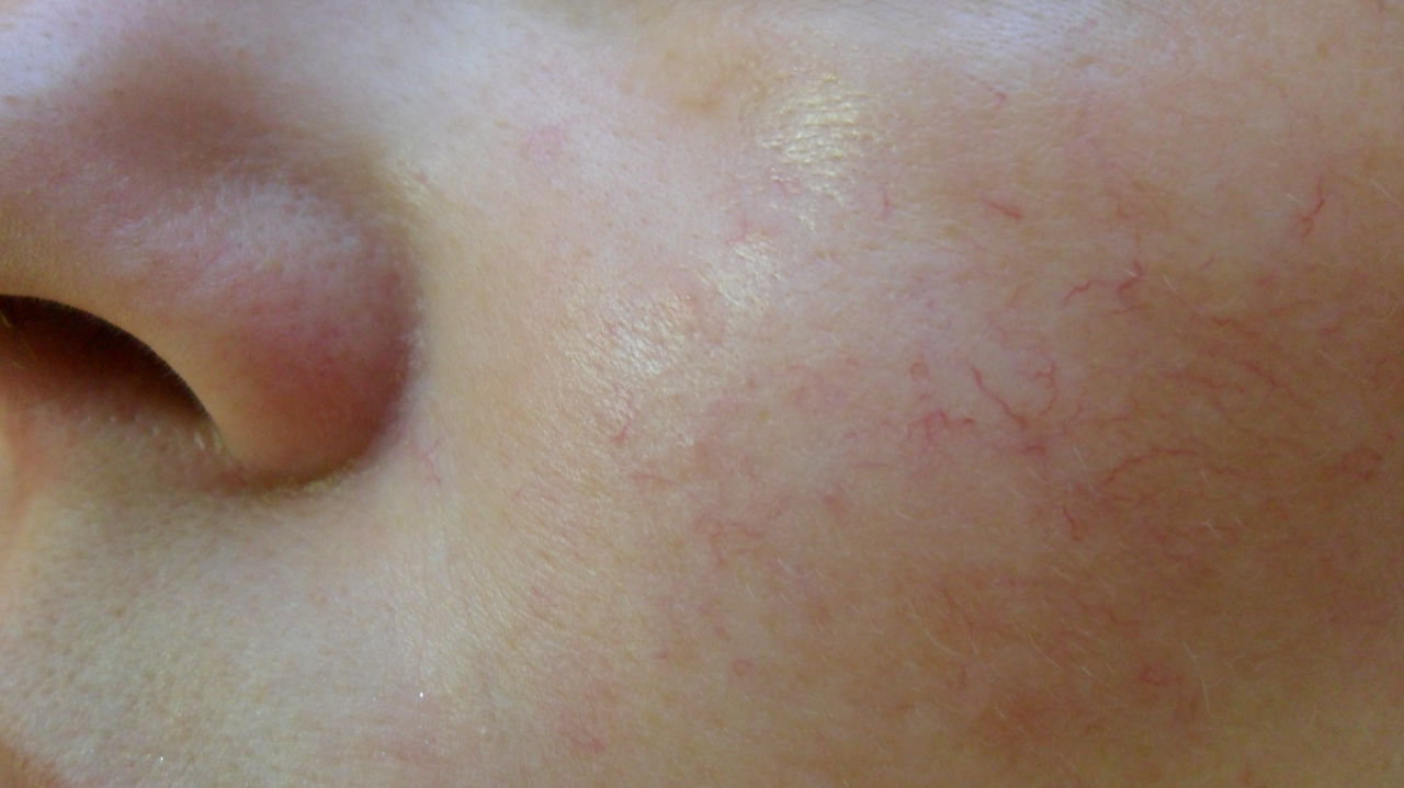 Симптомы купероза кожи лица