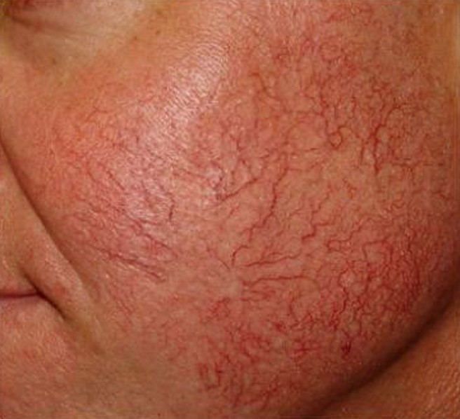 Развитие воспалительных процессов и нарушением микроциркуляции кожи