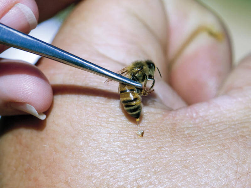 Пчелиный яд при варикозе ног