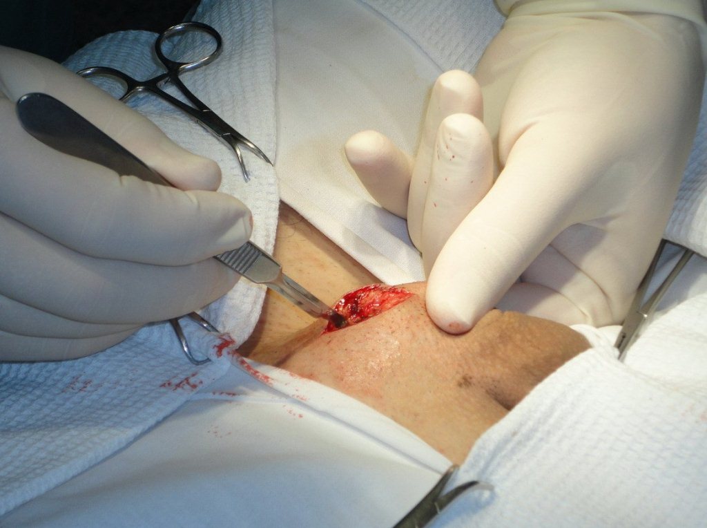 Хирургическое удаление кисты яичка у мужчин