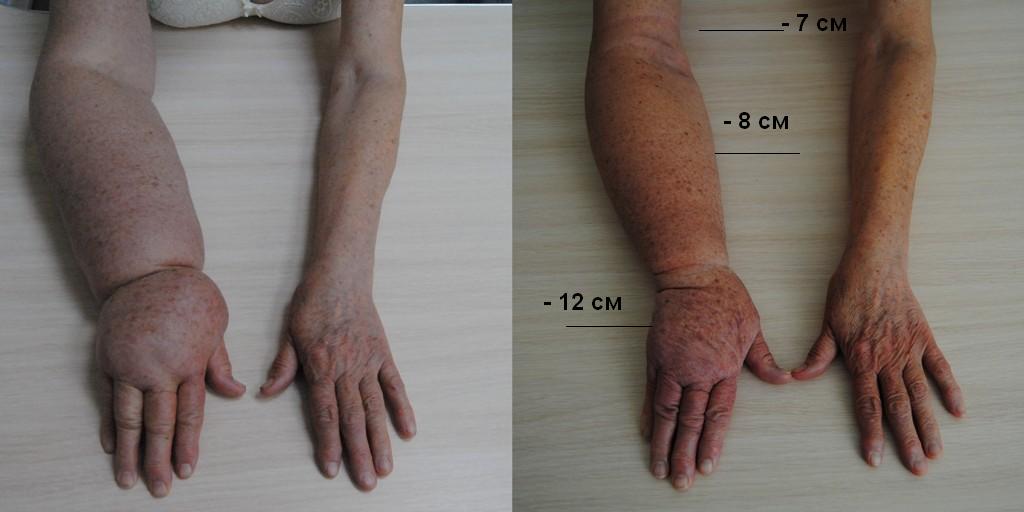 Лечение лимфостаза руки после мастэктомии 