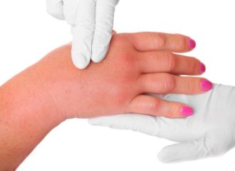 Массаж руки при лимфостазе после мастэктомии - техника проведения