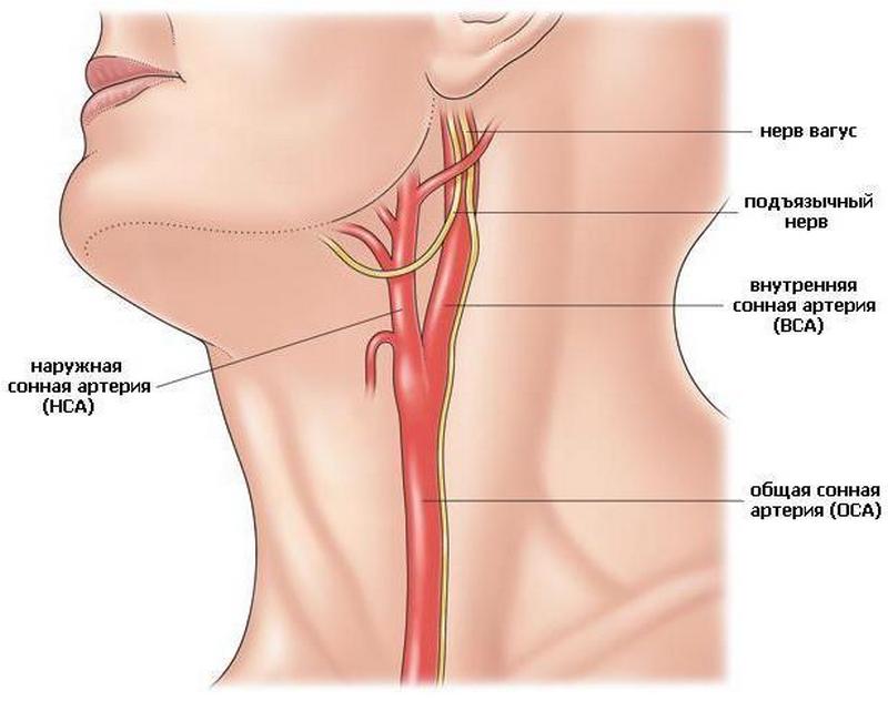 Атеросклероз внечерепных отделов брахиоцефальных артерий