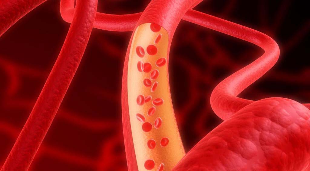 Атеросклероз - заболевание артерий