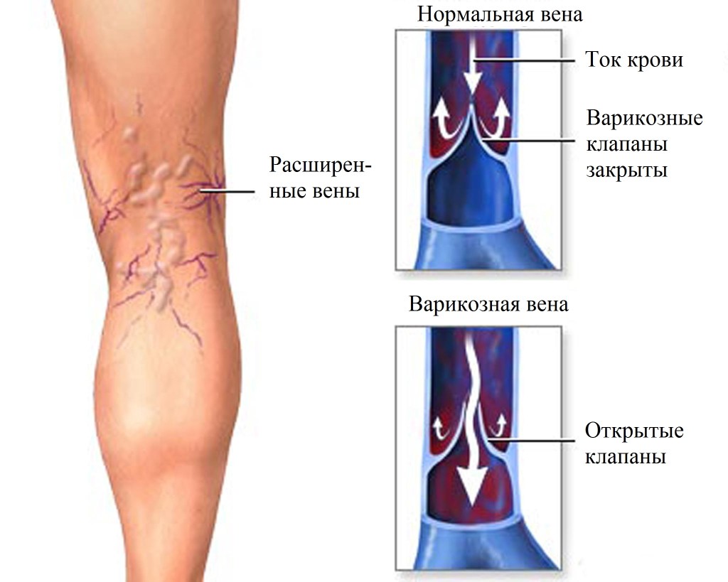 Причины варикоза на ногах