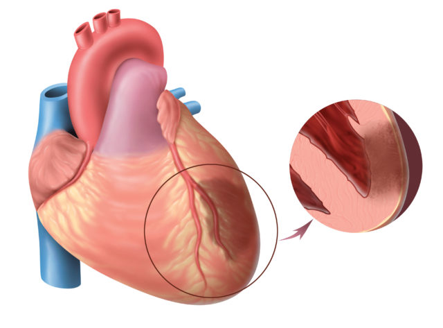 Степень осложнений зависит от формы болезни. Чаще всего при обширном инфаркте сердце утрачивает нормальную способность сокращаться, поэтому у пациента развиваются различные аритмии