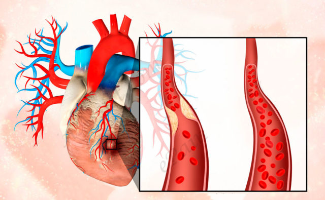 Разрыв бляшки, которая может находиться где угодно в сосудистой системе, приводит к закупорке (тромбозу) коронарной артерии оторвавшимся от бляшки тромбом