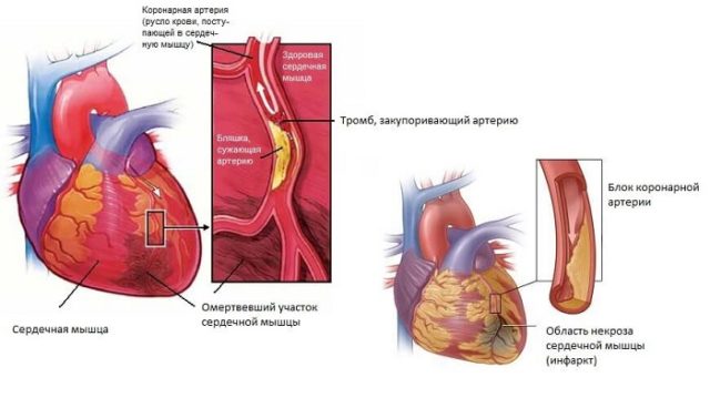 Инфаркт или некроз сердечной мышцы проявляется в результате ишемической болезни сердца