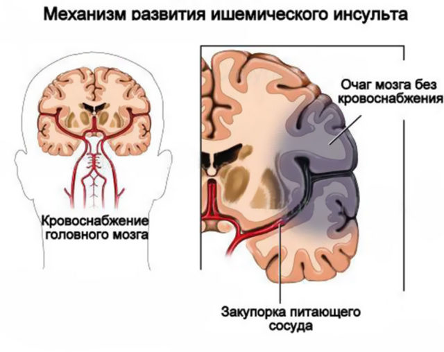 Клиническая картина хронической ишемии головного мозга складывается из головных болей, головокружений, снижением когнитивных функций 