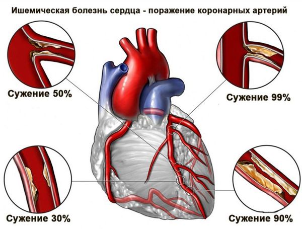 Патология развивается из-за того, что уменьшается приток крови к сердцу, так как коронарные артерии сужаются