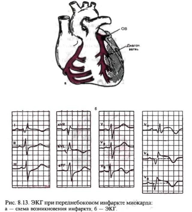 ЭКГ при инфаркте миокарда служит для врача бесспорным авторитетным доказательством