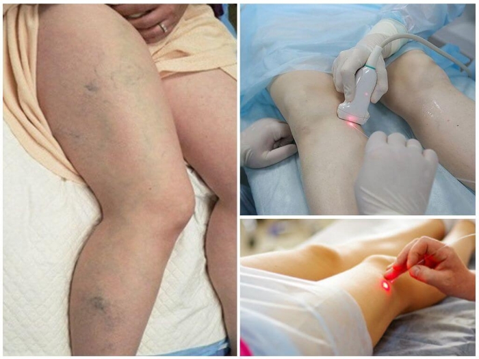 Лечение лазером варикоза вен на ногах