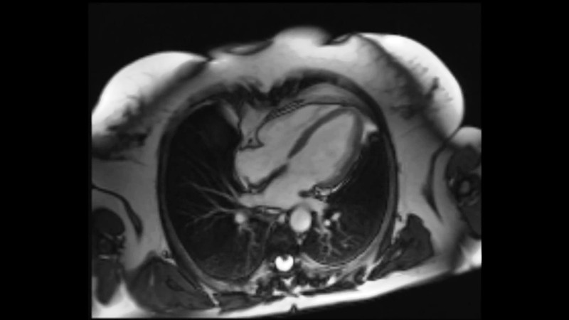 Снимок МРТ сердца 