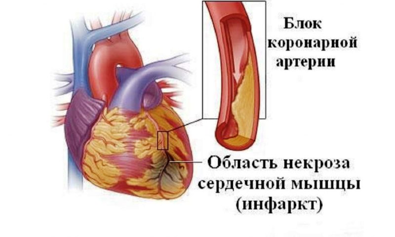 Принцип возникновения инфаркта 