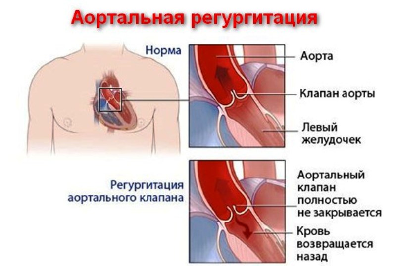 Аортальная регургитация