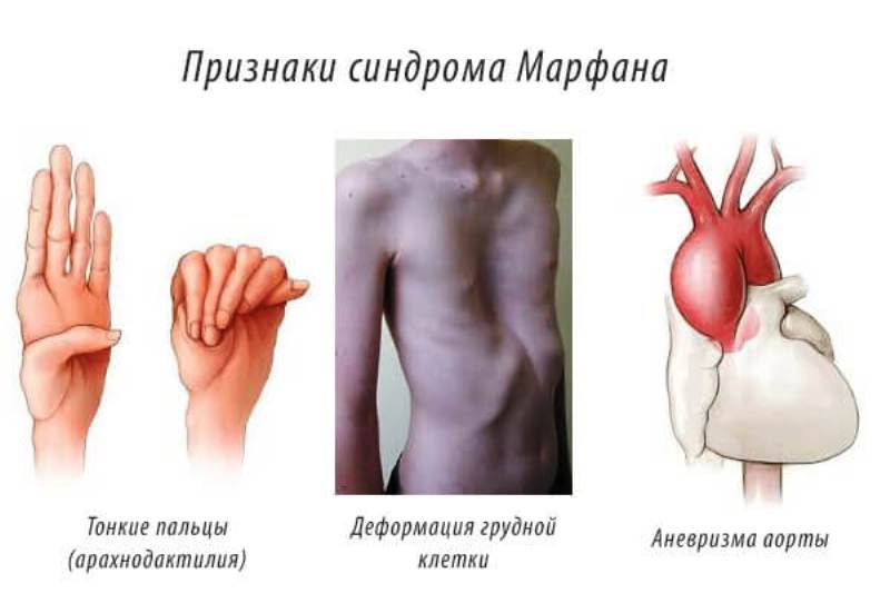 Синдром Марфана и аневризма аорты