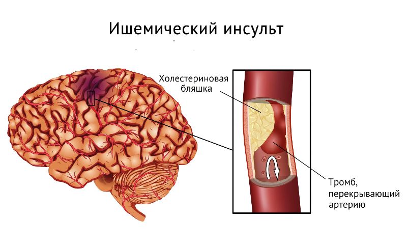 Ишемический инсульт мозга 