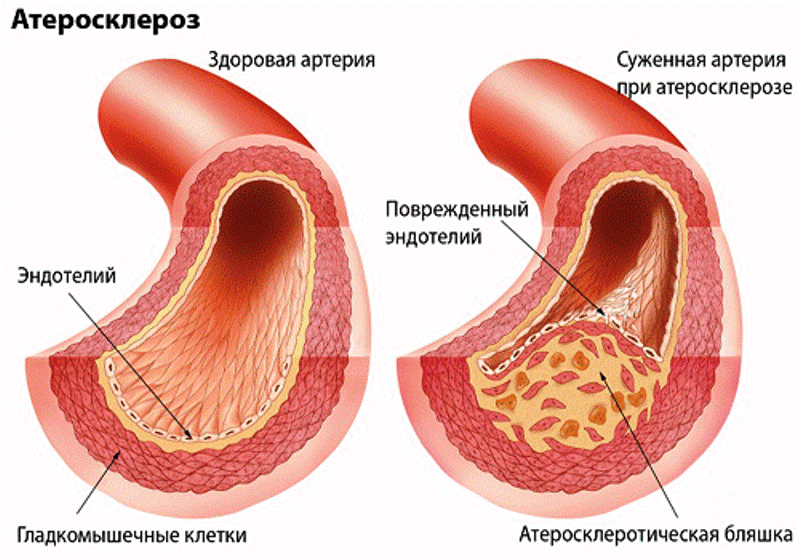 Здоровая и суженая артерии 