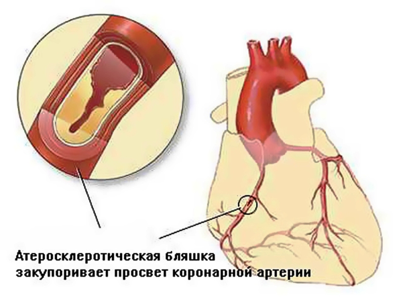 Закупоренная артерия
