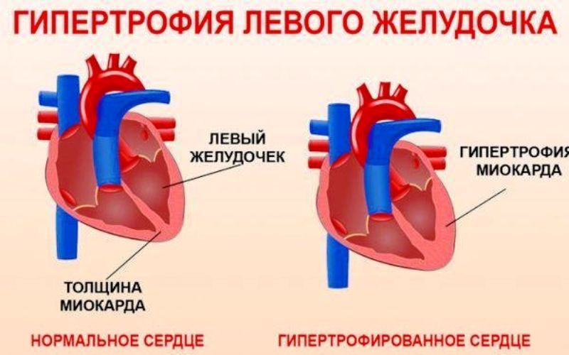 Нормальное и гипертрофированное сердце