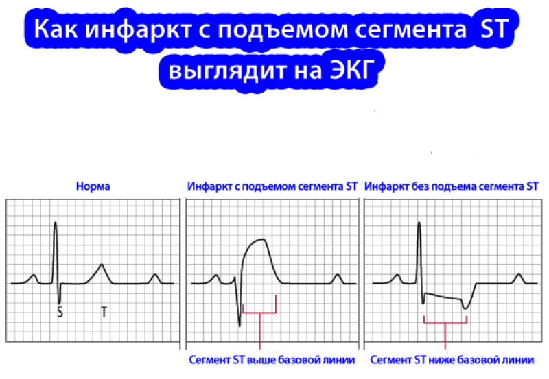 ЭКГ при инфаркте миокарда с подъемом ST 