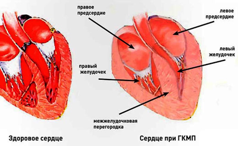Расположение передней стенки левого желудочка
