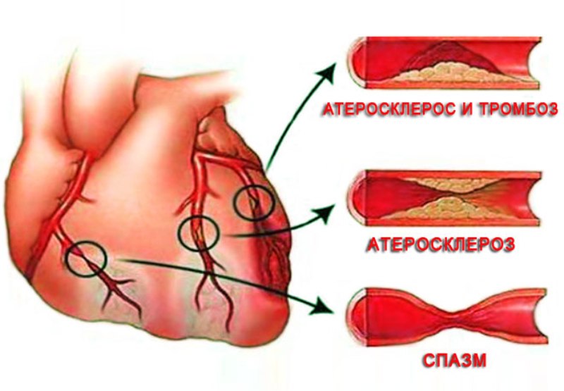 Стеноз артерий 