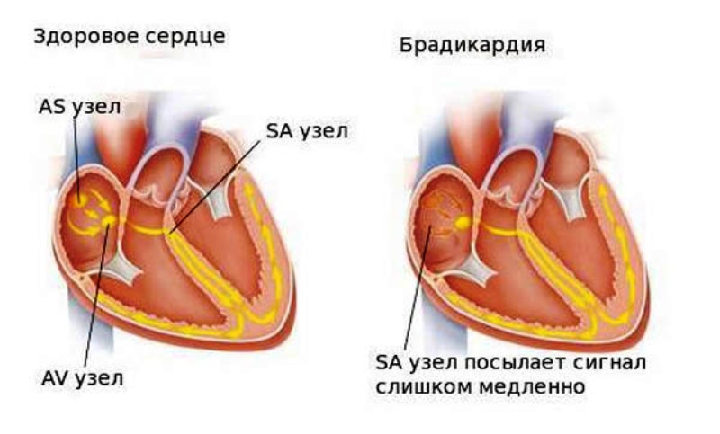 Здоровое сердце и брадикардия