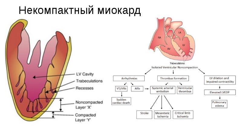 Схематическое изображение этого типа заболевания сердца
