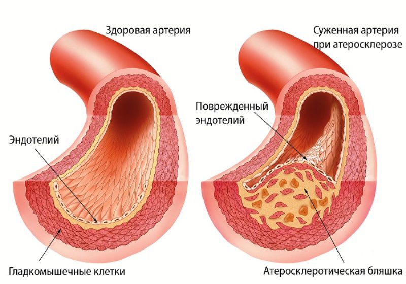 Здоровая и атеросклеротическая артерия 