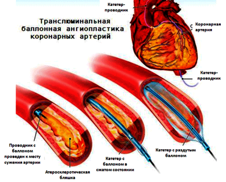 Баллонная ангиопластика коронарных артерий