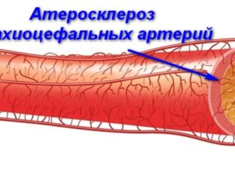 атеросклероз брахиоцефальных артерий