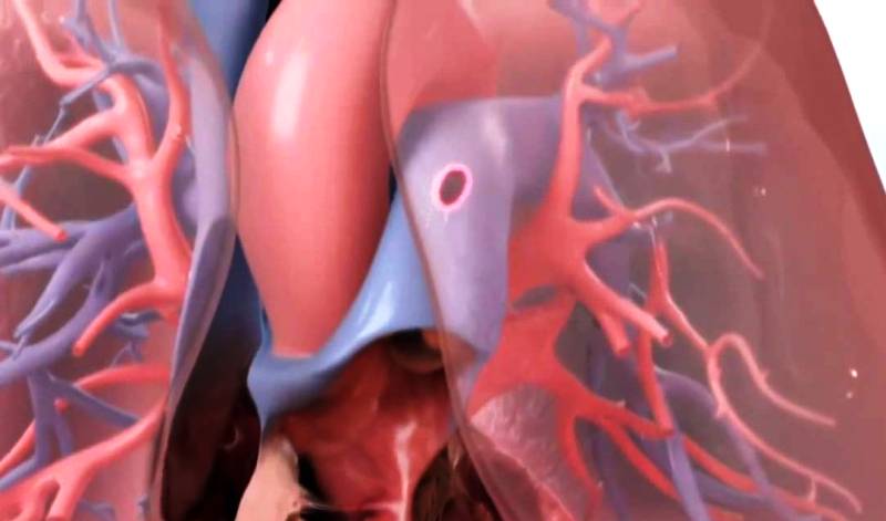 Тромбоэмболия легочной артерии
