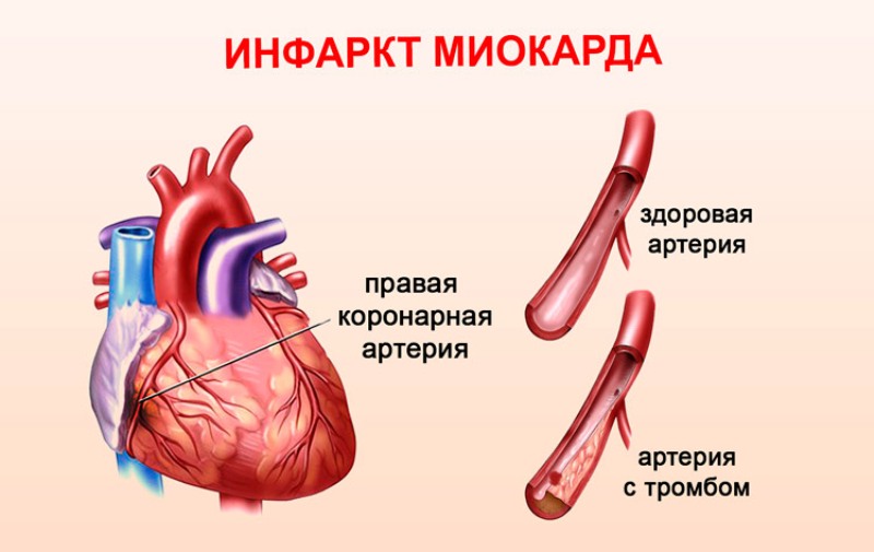 Здоровая артерия и артерия с образовавшимся тромбом